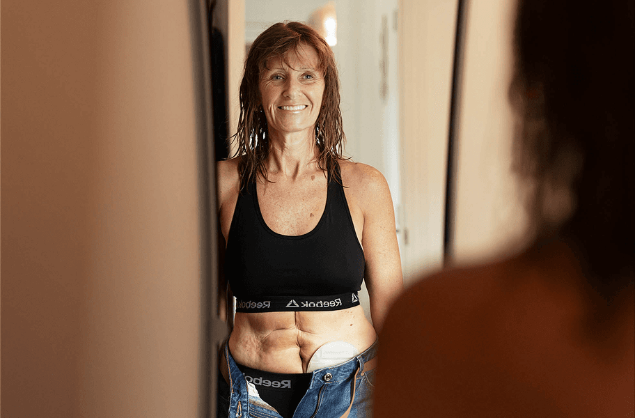 woman with stoma looking in mirror